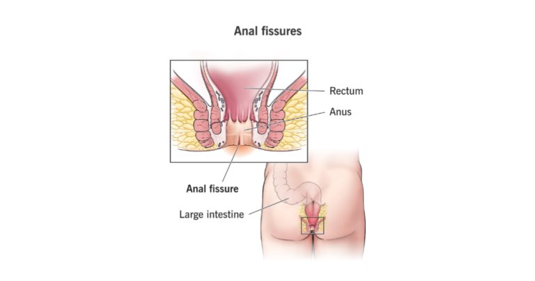 এনাল ফিসার থেকে মুক্তির উপায়