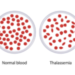 থ্যালাসেমিয়া কি