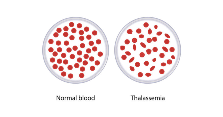 থ্যালাসেমিয়া কি