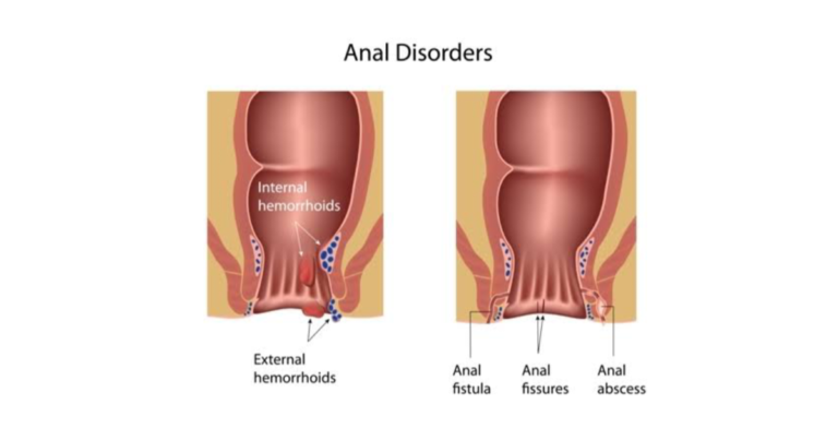 পাইলস ফিশার ও ফিস্টুলার মধ্যে পার্থক্য