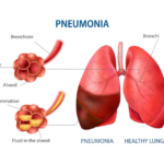 নিউমোনিয়া রোগের লক্ষণ