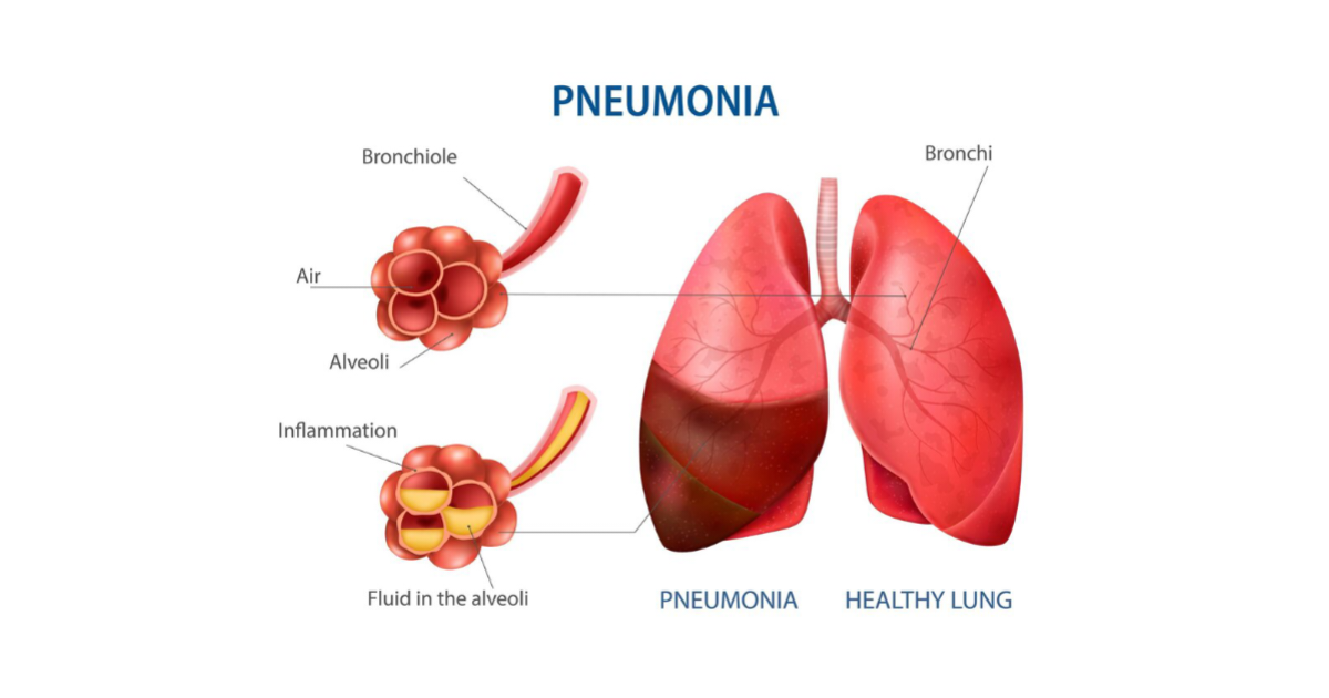 নিউমোনিয়া রোগের লক্ষণ