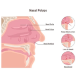 নাকের পলিপাস এর ড্রপ