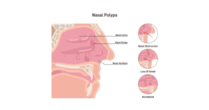 নাকের পলিপাস এর ড্রপ